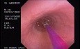 Zollinger- Ellison Syndrome - Gastric Ulcer with Gastrocolic Fistula (15 of 21)