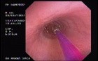 Zollinger- Ellison Syndrome - Gastric Ulcer with Gastrocolic Fistula (15 of 21)