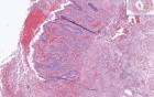 Appendix- Acute Appendicitis- Self-Leraning Module – Cell Injury And Inflammation 2