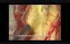 Spinal Cord Tumor - Cervical Intramedullary - Microsurgical removal