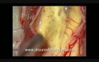 Spinal Cord Tumor - Cervical Intramedullary - Microsurgical removal