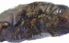 Gallbladder Adenocarcinoma and litiasis (1 of 13)
