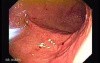 Percutaneous Endoscopic Gastrostomy - PEG (3 of 6)