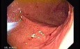 Percutaneous Endoscopic Gastrostomy - PEG (3 of 6)