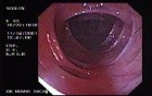 Diverticular Disease - Hemorrhage (12 of 15)