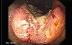 Gastric Adenocarcinoma With Varices - Endoscopy (4 of 8)