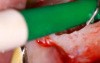Maxillary Molar Microsurgery

