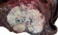 Lung Adenocarcinoma (1 of 5)