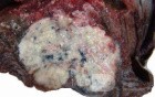 Lung Adenocarcinoma (1 of 5)