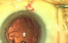 Fugo Plasma Capsulotomy: Stripping Cortex Peripherally .Small Capsulotomy Rim Surgery