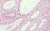 Rectal Adenocarcinoma that infiltrates the second and the 
 third valve (4 of 5)