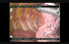 Radio Guided Occul Lesion Localisation