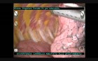 Radio Guided Occul Lesion Localisation