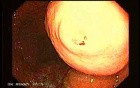 GIST With Ulcerated Lesion (1 of 6)
