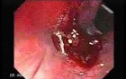 Endoscopic Resection of Giant Tubulo-Villous of the rectum (7 of 35)