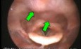 Cervical Spondylosis 