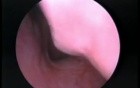 Adenoids - Endoscopic View