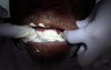 Removable Denture Clasp Repair Part 2 - Alginate Pickup Impression