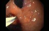 Gastric Varices - Endoscopic Ablation With Cyanoacrylate Glue (8 of 18)