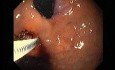 Gastric Varices - Endoscopic Ablation With Cyanoacrylate Glue (8 of 18)