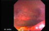 Upper Gastrointestinal Bleeding - Posthemorrhagic Appearance
