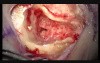 Right Cochlear Implantation