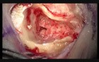 Right Cochlear Implantation