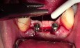 Uncovery #23 & 26 - Biomet 3I Nanotite Implants - Paracrestal Incision & Sling Suturing 