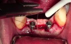 Uncovery #23 & 26 - Biomet 3I Nanotite Implants - Paracrestal Incision & Sling Suturing 