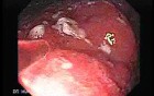 Non-Hodgkin B-Cell Lymphoma - Assessment of the Lesions, Part 2