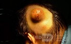 Dermoid Cyst Of Scalp