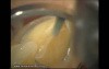 Final Preparation For Aesthetic Veneers (2/4)
