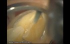 Final Preparation For Aesthetic Veneers (2/4)