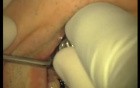 Loading Of Early Prosthesis 16-17-25-26-27 (2/3)