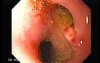 Choledocoduodenostomy and The Sump Syndrome (3 of 10)
