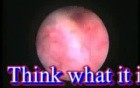 Uterus In Endoscopy