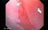 Barrett Esophagus - endoscopic view  (2 of 9)