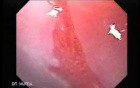 Barrett Esophagus - endoscopic view  (2 of 9)