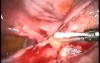 Laparoscopic Lysis Of Adhesions After Pelvic Inflammation Disease