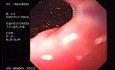 Banding of esophageal varices (14 of 17)