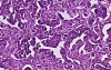 Adenocarcinoma - Histopathology of ovary