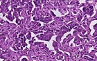 Adenocarcinoma - Histopathology of ovary