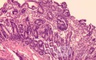 Duodenal Mucosa in Celiac Disease (5 of 6)