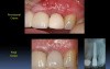 Immediate Implantations For Begginers