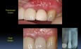 Immediate Implantations For Begginers