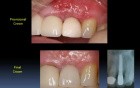 Immediate Implantations For Begginers