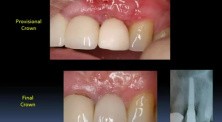 Immediate Implantations For Begginers