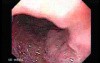 Long Standing Alcohol Abuse - 68 Years-Old Man