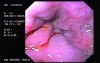 Hemorrhage due status post rubber band ligation of esophageal varices (11 of 25)