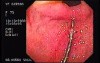 Esophageal Achalasia  (5 of 16)
